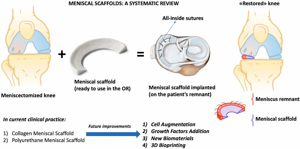 meniscal scaffolds